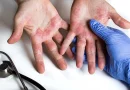 Manos limpias y piel sana: el reto para personas con dermatitis atópica